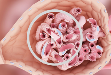 Nephrotic
